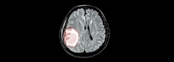 Brain Tumor In Dogs: Symptoms And Treatment
